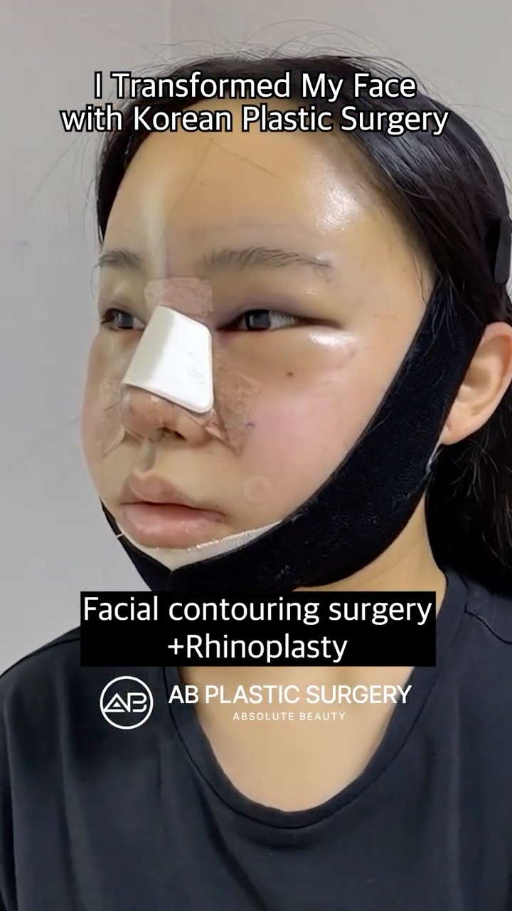 I Transformed My Face with Korean Plastic Surgery #shorts