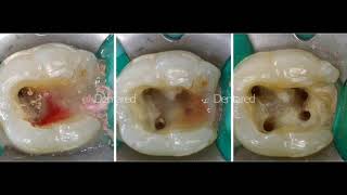 Primer molar inferior by Ricardo Rivas 37,651 views 3 years ago 8 minutes, 6 seconds