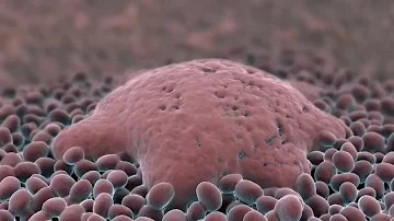 ¿Qué tipos de cáncer provocan sudoración?