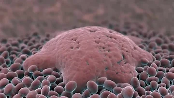 ¿Qué tipos de cáncer provocan sofocos y sudoración?