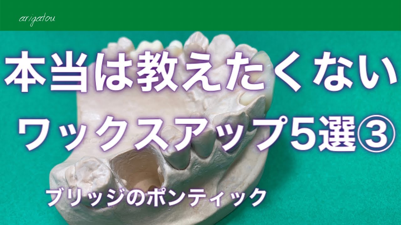 【歯科技工士】ブリッジのポンティックのワックスアップ