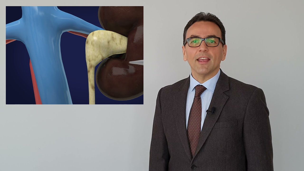 Robotik Piyeloplasti: UPJ Darlığında Böbreği Korumak Mümkün mü?