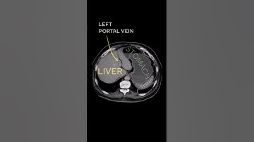 CT abdomen anatomy #radiology #radiologist #physician #medicine #medical #medicalschool #doctor
