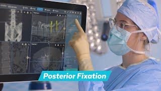 Excelsius® Lateral 360 Posterior Fixation