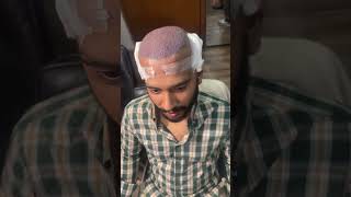 Referred Client Chooses FUE Turkish Hair Transplant at Hair Zone | Best Hair Transplant in Pakistan