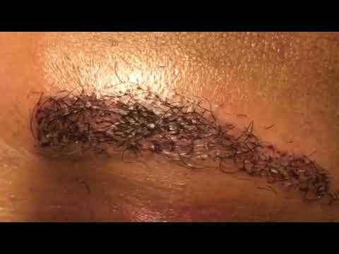 Dallas Corrective African-American Male Eyebrow Hair Transplant 1 Day Out