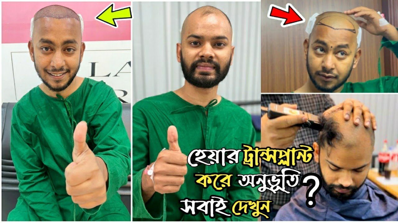 বাংলাদেশে সবচেয়ে কম খরচে হেয়ার ট্রান্সপ্লান্ট Hair Transplant in