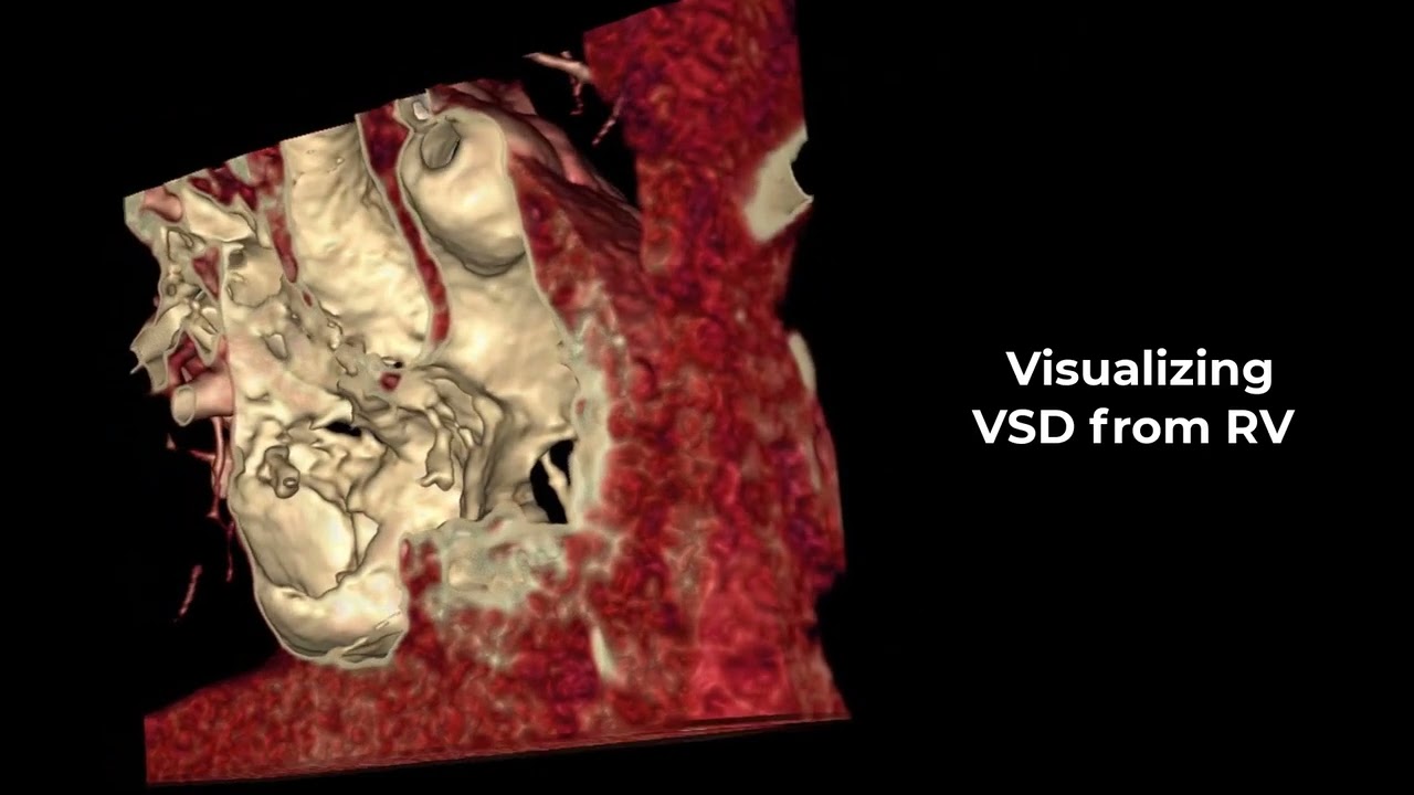 Imaging/Modeling to Assess Transcatheter vs Surgical Repair of Large Apical Muscular VSD (Case 3)