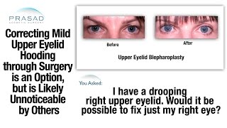 Slight Upper Eyelid Asymmetry Is Common And Unnoticeable To Other People - Surgery Is Option Only