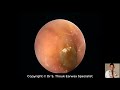 Earwax Removal Extraction Peer Dr Thouk Earwax Specialist Chip Earwax #3