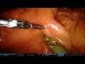 Robotic Ascending Colectomy with Intracorporeal Anastomosis