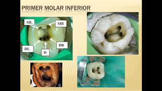 Acceso a la pulpa dental del Molar Inferior by Ricardo Rivas 10,958 views 3 years ago 5 minutes, 33 seconds