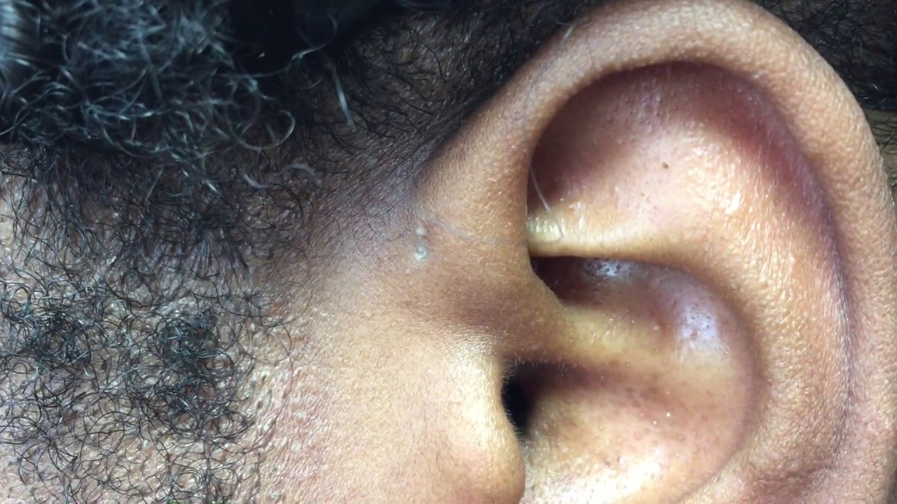 Congenital Preauricular Fistula YouTube