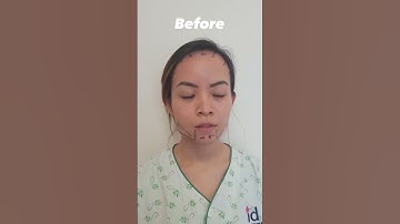 Full Face Transformation
