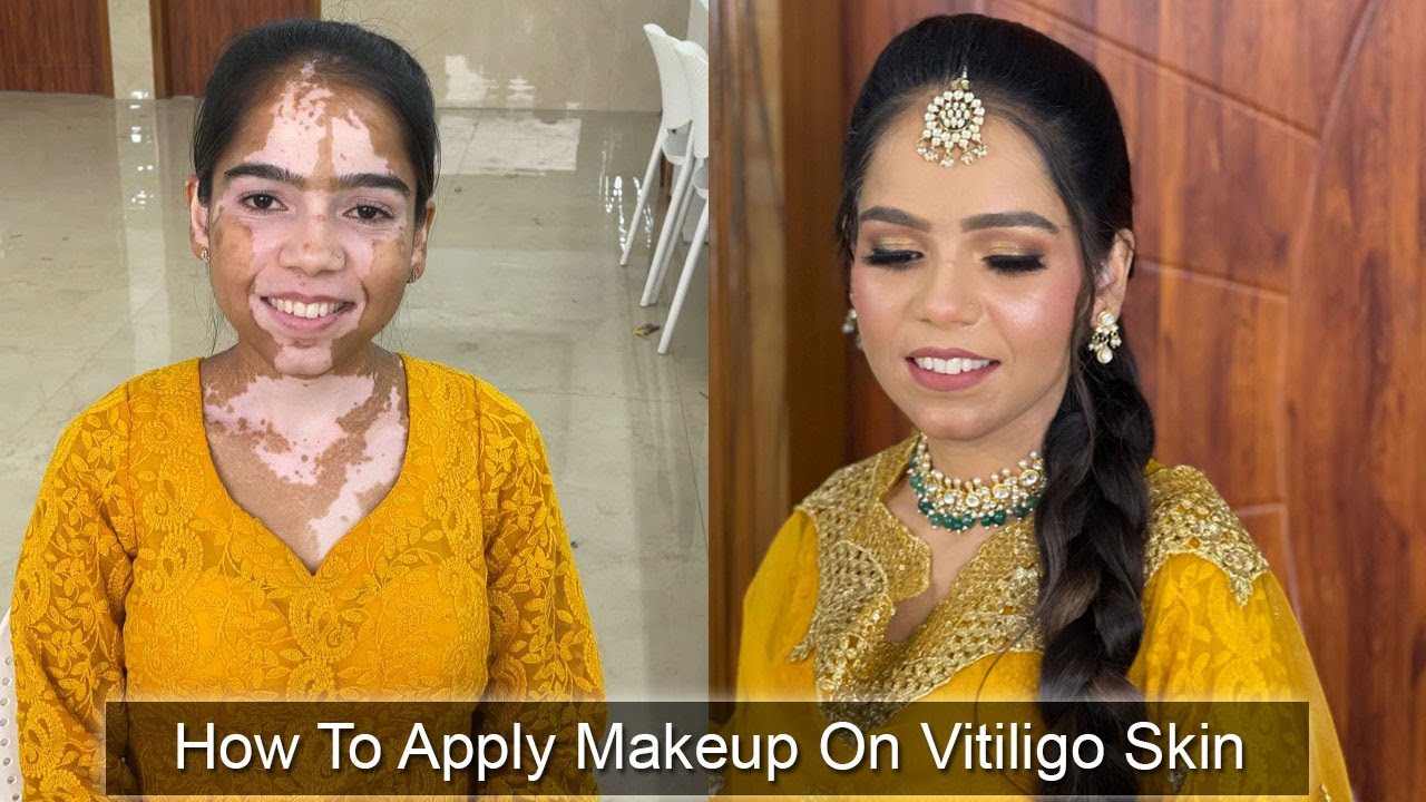 How To Apply Makeup On Vitiligo Skin | Step By Step Tutorial