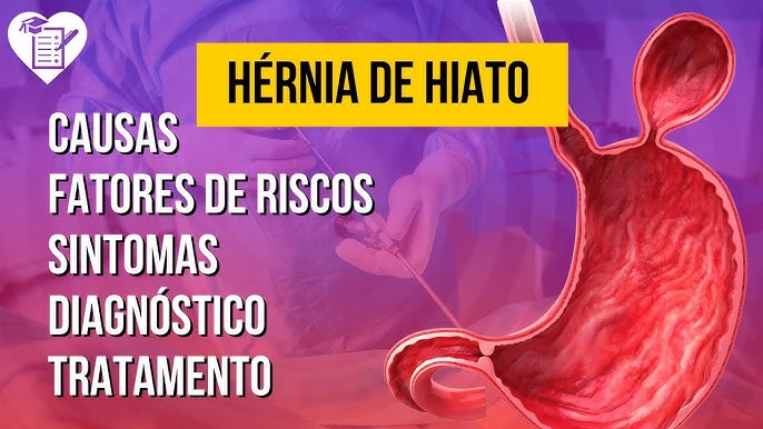 6 passos para recuperação após cirurgia de hérnia de hiato - SBH