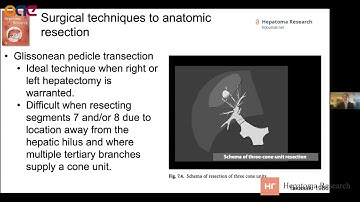 Scientists present their video abstract about liver resection from Hepatoma Research
