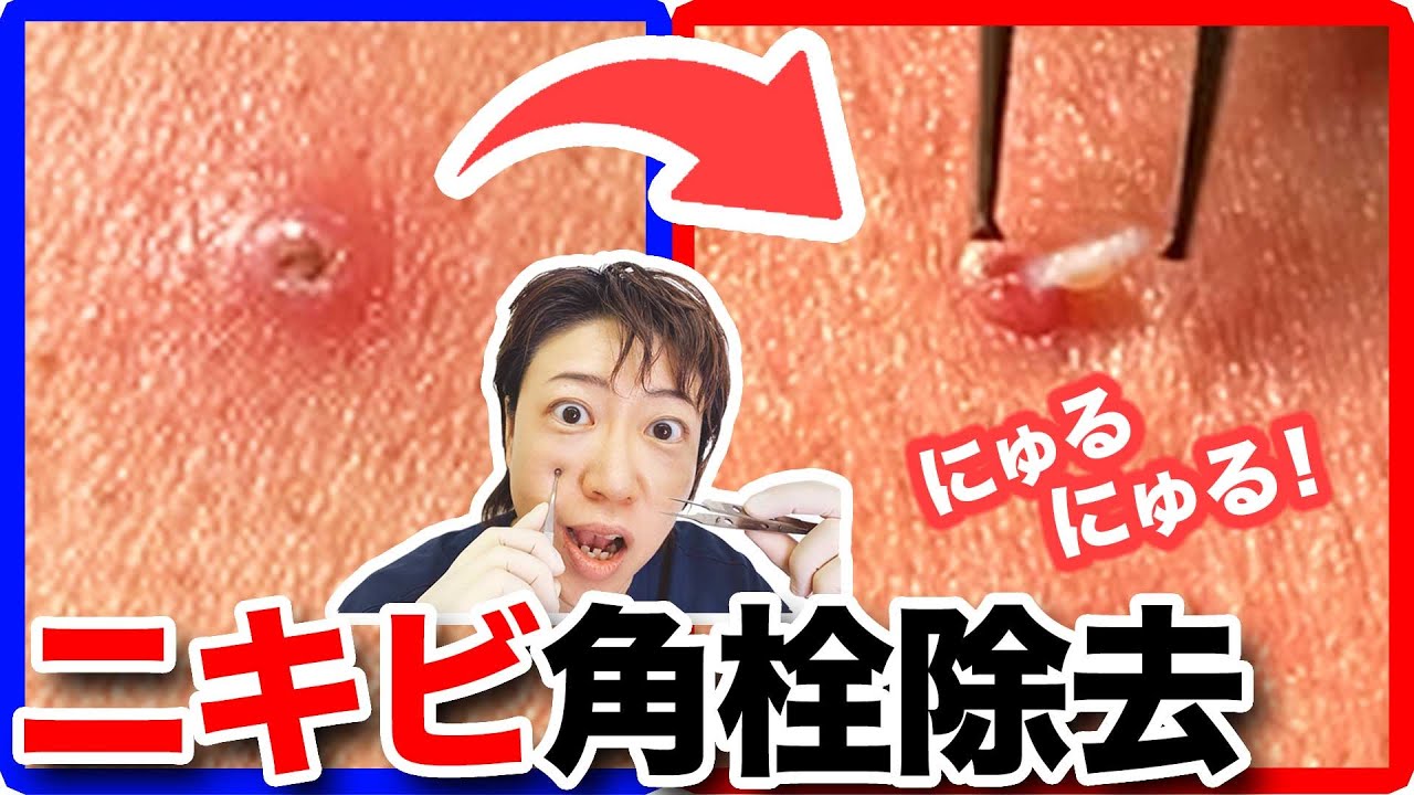 閲覧注意 ニキビの角栓を医師がにゅるっと除去しちゃいます Youtube