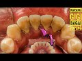 Scaling Calculus Tartar Removal | Karang Gigi Bagai Topeng | @Dokter Gigi Ruliyanto