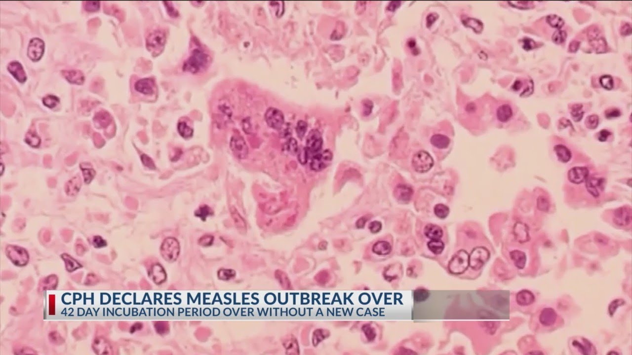 Central Ohio measles outbreak over, Columbus Public Health says YouTube