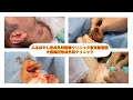 頚部　首の粉瘤　４cm大　ブログで解説入れてます。東京皮膚のできものと粉瘤クリニック　ふるばやし形成外科新宿院　大阪梅田形成外科クリニック