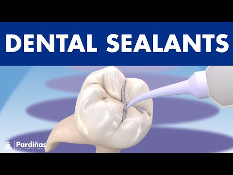 How to PREVENT CAVITIES - Dental sealants ©