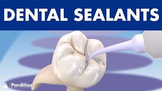 How to PREVENT CAVITIES - Dental sealants ©