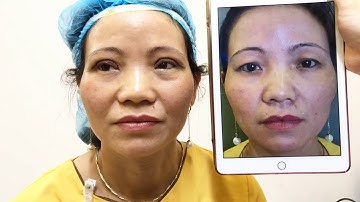 Kết Quả Cắt Mí Mani Open Deep 5D Tại Dr.Hải Lê.