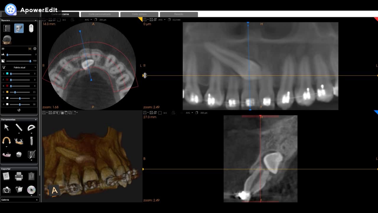 Avaliando TCFC: canino incluso
