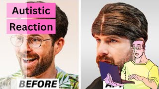 Autistic Man Reacts: 'I Regret My Turkish Hair Transplant' @smosh