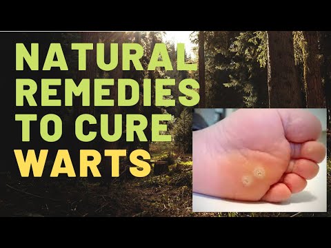 Natural Remedies For Curing Warts - Home Remedies For Warts Removal