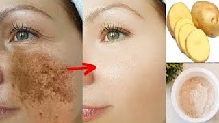 How to use potato to treat skin pigmentation Dark spot acne scars easily at home || Home remedies||