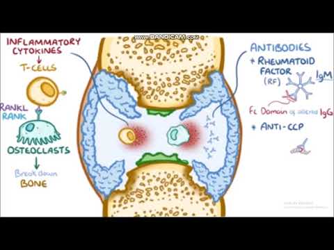 Video: Reaktivní Artritida - Příčiny, Příznaky A Léčba Reaktivní Artritidy