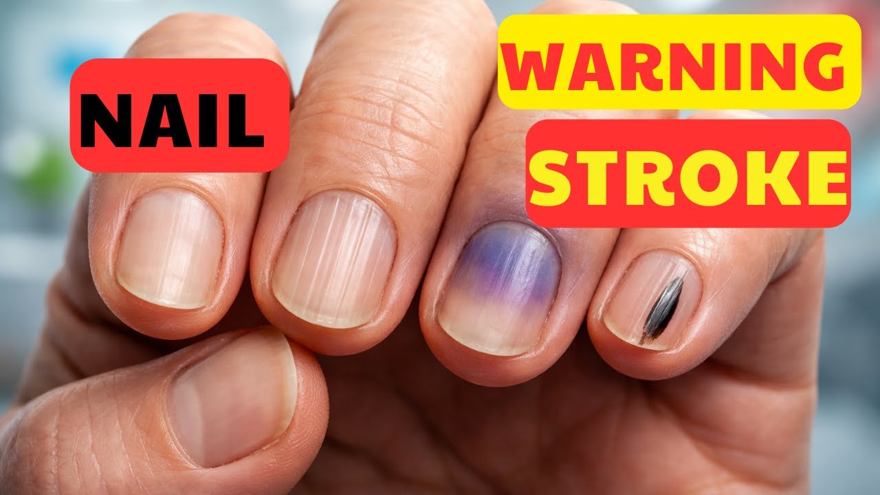 5 Fingernail Signs That Warn a Stroke Is Coming