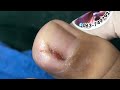Ep_6555 *Ingrown toenail removal 👣 มันแข็งมาก ๆ ลูก 😄 (clip from Thailand)