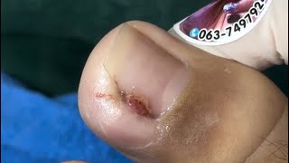 Ep_6555 *Ingrown toenail removal 👣 มันแข็งมาก ๆ ลูก 😄 (clip from Thailand)