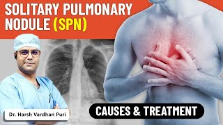 What Is Solitary Pulmonary Nodule (SPN) | Symptoms And Treatment Of SPN In Hindi #spn Delhi NCR screenshot 2
