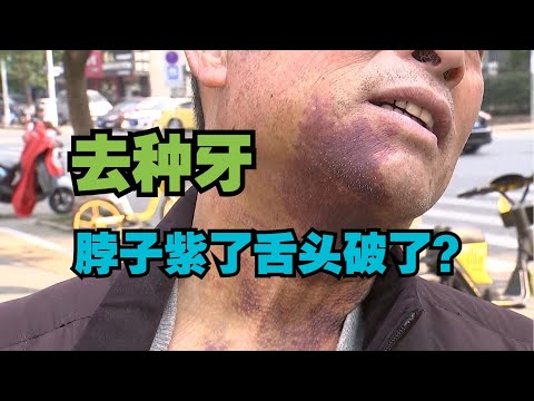 【1818黄金眼】大伯种牙先增骨，舌头破了脖子紫？