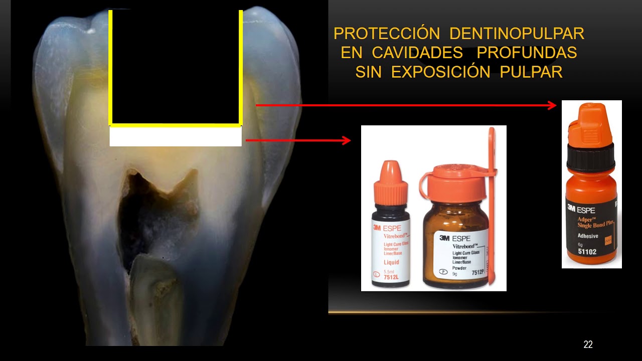 Protección dentino Pulpara   Principios de la Adhesion