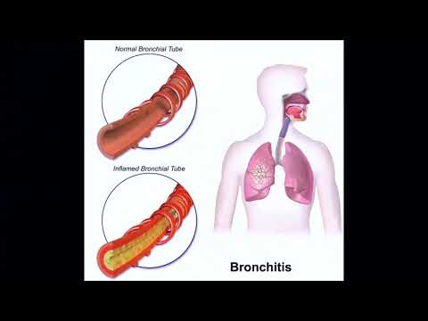после бронхита остался кашель с мокротой
