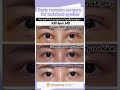 Early revision eyelid surgery  early eyelid correction surgery before and after