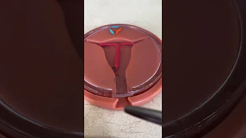 Como é feita a retirada do DIU?