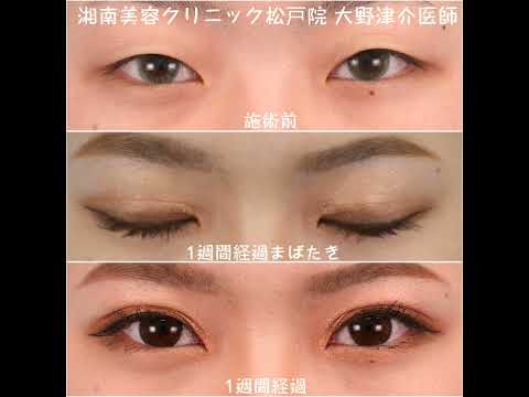 湘南美容クリニック松戸院院長大野津介医師による埋没二重術 Youtube