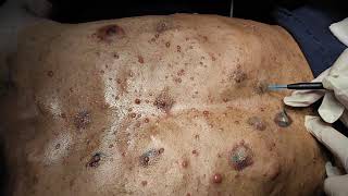 Cutaneous Neurofibroma removal by RF technique