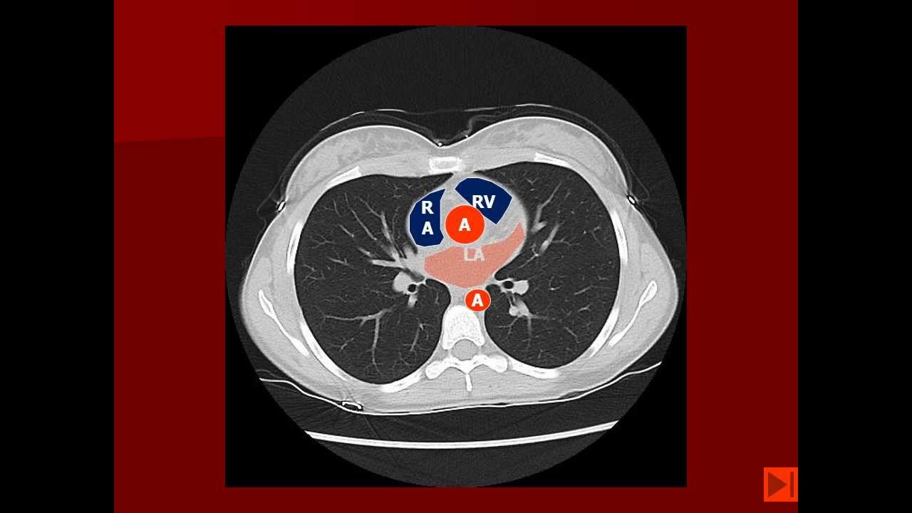 Normal Chest Ct Scan Images Ct Scan Machine