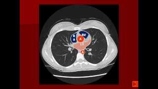 Normal Chest CT with labels