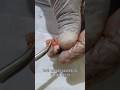 Impacted Wisdom Tooth Surgery | Satisfying Removal #wisdomtoothremoval #oralsurgery #shorts