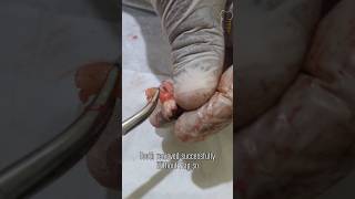 Impacted Wisdom Tooth Surgery | Satisfying Removal #wisdomtoothremoval #oralsurgery #shorts