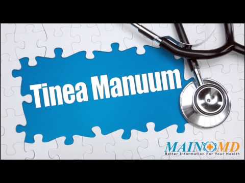 Tinea Manuum ¦ Treatment and Symptoms