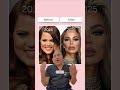 Dr. Newman Discusses Khloe Kardashian’s Before & After